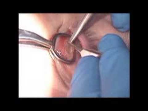 comment guerir chalazion