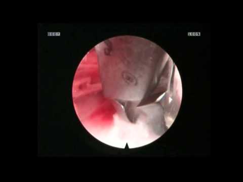 Hüfte Röntgenbild von launshteynu Heilung Kragen vom Hals Osteochondrose