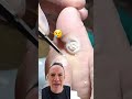 DOCTOR REACTS: AMAZING PLANTAR WART CURE! 😱 #shorts