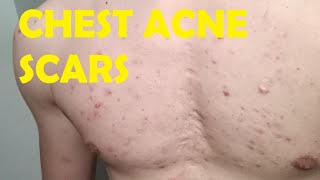 will chest acne scars ever go away