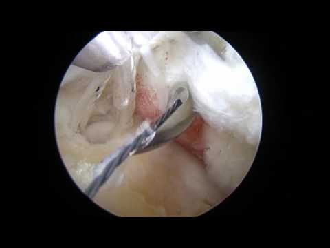 What is a Rotator Cuff Repair? | Shoulder Arthroscopy | Colorado Shoulder Surgeon