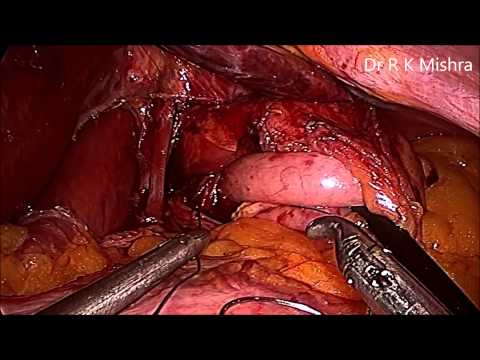 GERD - Surgical Treatment Fundoplication for Esophageal Disease