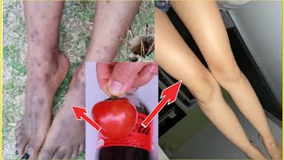 How To Get Rid Of Dark Spots Scar, Mosquito Bites, Hyperpigmentation on legs fast | Natural Remedies