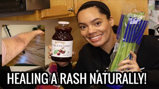 Healing a INTENSE ITCHY RASH NATURALLY | HOW TO get relief!