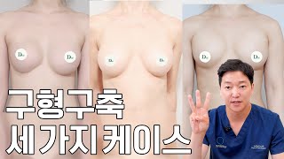 가슴부작용 1위 구형구축 케이스 리뷰