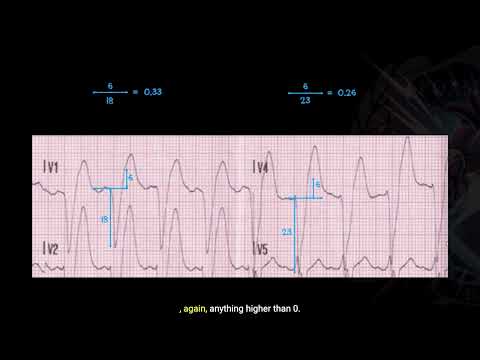 Understanding Smith Modified Sgarbossa Criteria - Good Reads