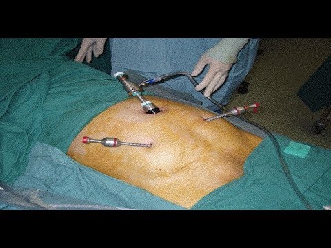 Kung paano mawalan ng timbang mabilis na may Dr. Kovalkova Iyon ay, kapag hindi naaangkop hudeesh
