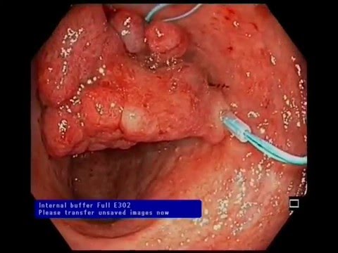 Endoloop Polypectomy