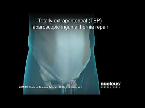 Totally Extraperitoneal (TEP) - Laparoscopic Inguinal Hernia Repair