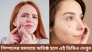 পিম্পল দূর করার জন্য কোন ফেসওয়াশ ব্যবহার করা উচিত।ব্রণ দূর করার জন্য সেরা ৫ টি ফেসওয়াশ