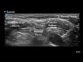 Ultrasound Phrenic Nerve Identification Prior to Interscalene Brachial Plexus Block