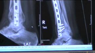 preview picture of video 'Broken Leg and Ankle Checkup X-Ray and Thrombosis Echo'