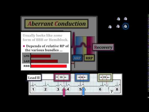 ECG Video-12 (Blog 113) - Rhythm Diagnosis: Part 3