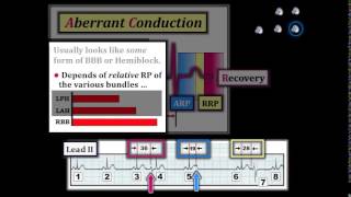 ECG Video-12 (Blog 113) - Rhythm Diagnosis: Part 3