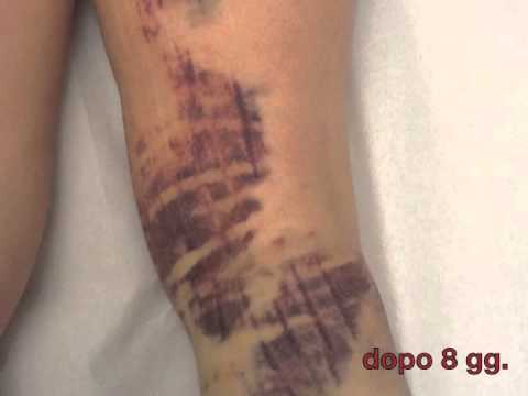 Espettorato di sangue, e il mal di schiena Riabilitazione dopo la rimozione della colonna vertebrale cervicale ernia