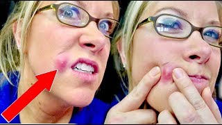 Staph Infection OR Spider-Bite?!