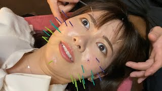 不適切なギャグで炎上した女芸人の顔中に針を刺しまくるお仕置き