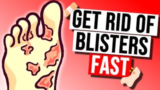 How To Get Rid of Blisters Fast in 2024