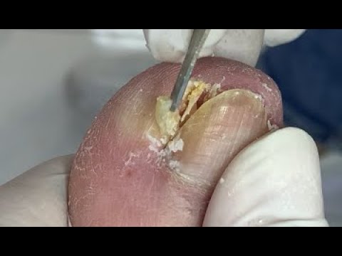 Professional nail cuticle cleaning