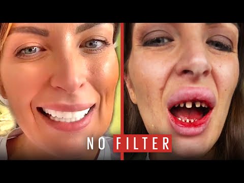 The Horrible Truth Behind My 'Turkey Teeth' | No Filter | @LADbible