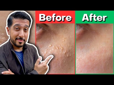 How to Get Rid of Milia | Treatment for Milia THAT WORKS ✅