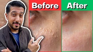 How to Get Rid of Milia | Treatment for Milia THAT WORKS ✅