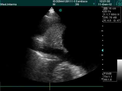 Pleuraerguss bei der Echographie-Untersuchung