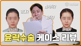 윤곽수술의 얼굴 변화 결과, 한눈에 알기 쉽게 바로 보여드립니다!!!｜윤곽수술 케이스 리뷰(1)