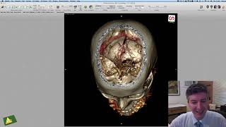 Angiografia Cerebral