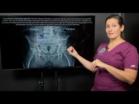 Sciatica and leg length discrepancy connection to Sacroiliac joint instability