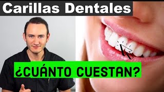 Carillas Dentales | ¿Qué son y Cuánto cuestan | Precios actuales