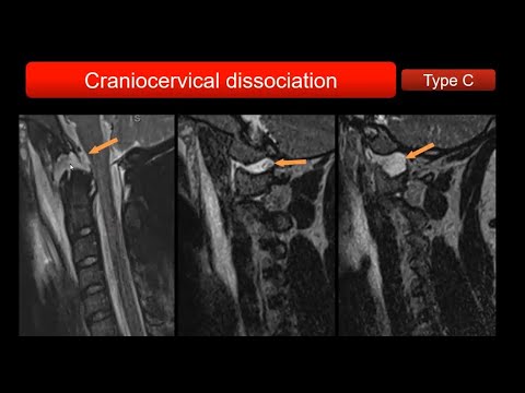 Emory MSK E-Lecture Series - Dr. Ryan Peterson