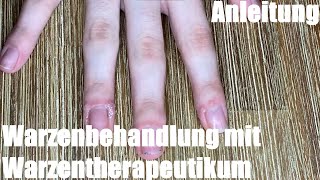Warzenbehandlung mit Warzentherapeutikum - Warzen entfernen mit Verrunal Anleitung