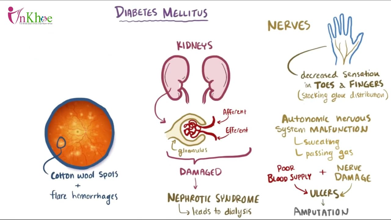 Bệnh đái tháo đường