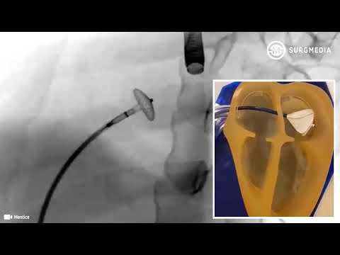 How it works? Transcatheter closure of Atrial Septal Defect (ASD)