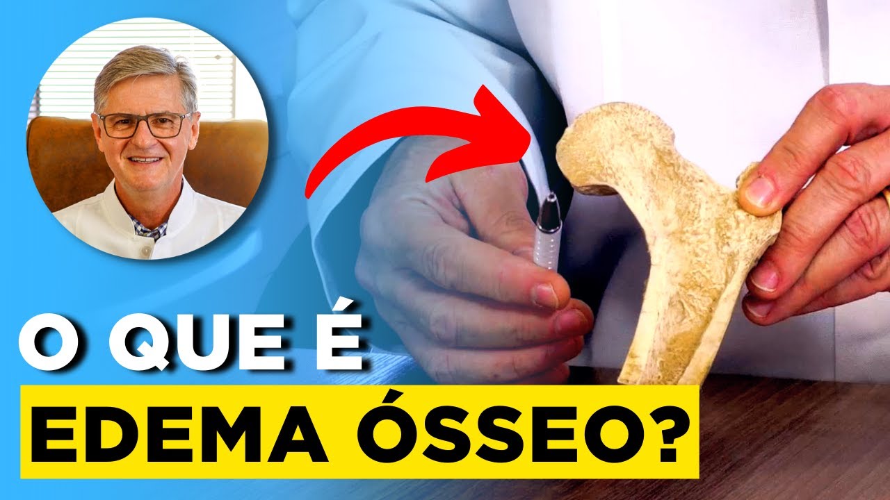 Edema Ósseo (Sintomas, Diagnósticos e Tratamentos) | Robert Wagner