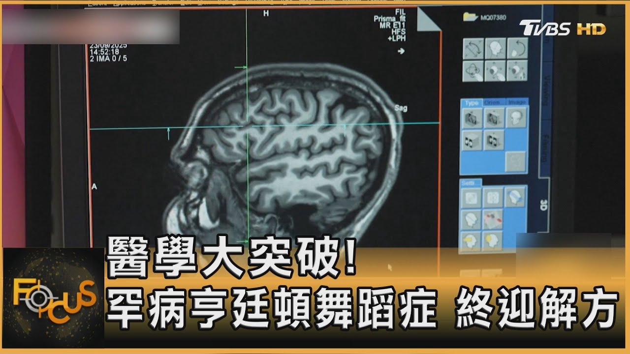 醫學大突破!罕病亨廷頓舞蹈症 終迎解方