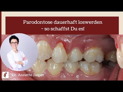 Parodontose dauerhaft loswerden - so schaffst Du es!