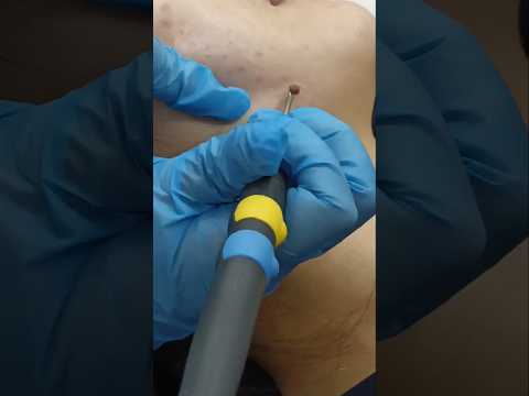 Watch This Mole Vanish Instantly | Precision Laser Mole Removal