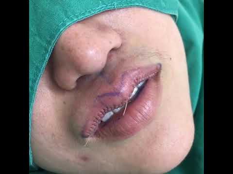 Areolas ครีมเต้านม อาหารเสริมเต้านม