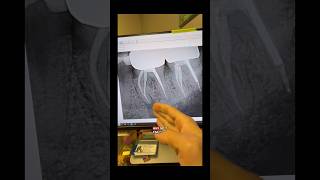 No cbct. #dentists #dentalcare #rootcanaltherapy