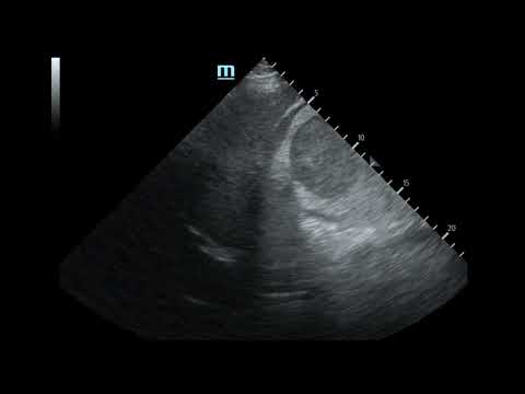 Massive Traumatic Retroperitoneal Hematoma, US 1 Unannotated