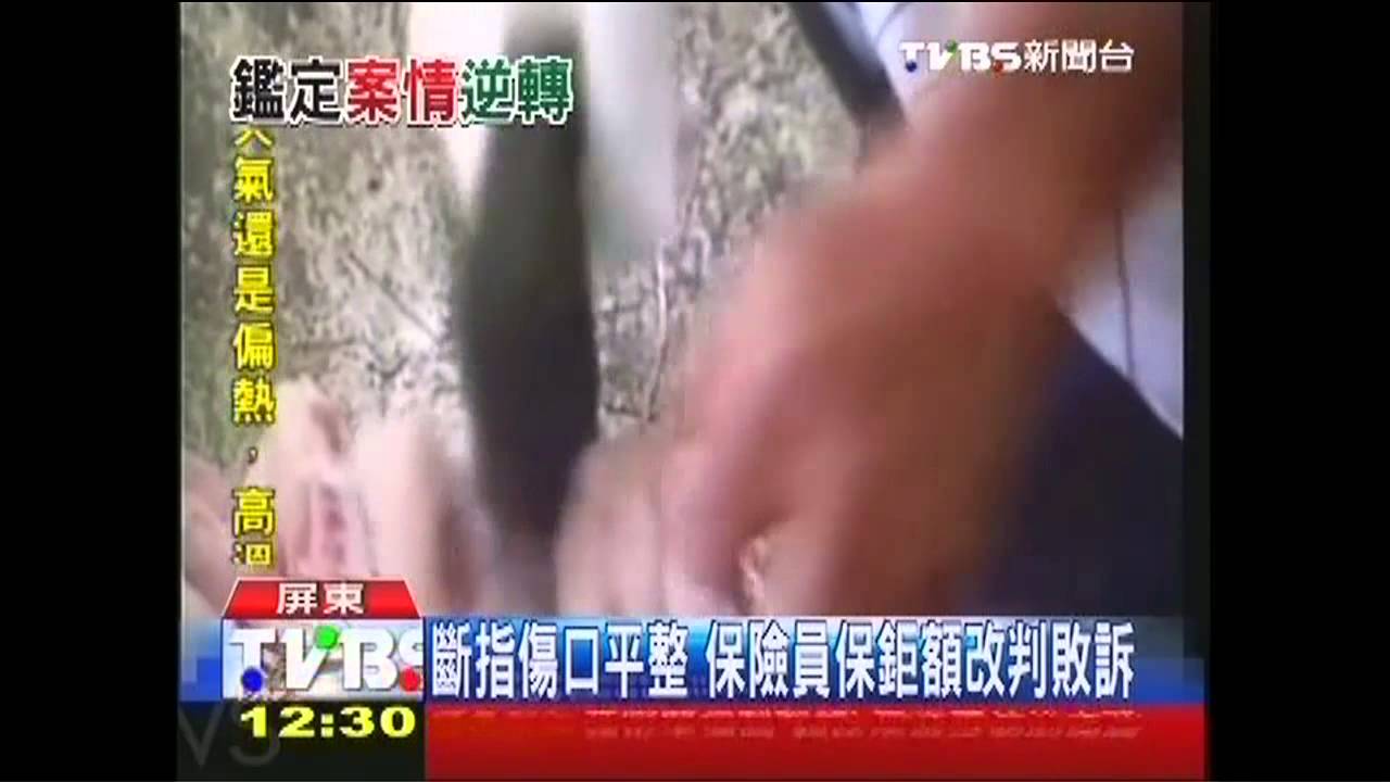 斷指傷口平整 保險員保鉅額改判敗訴