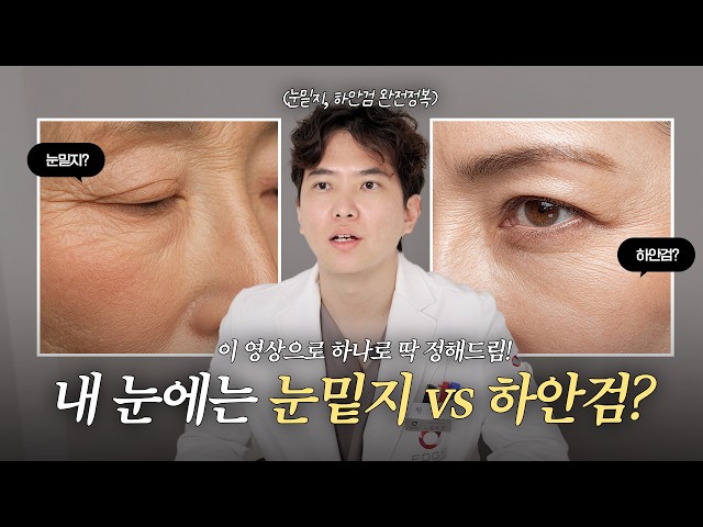 [40대 눈밑성형] 눈밑지방·처짐으로 나이 들어 보인다면 무조건 하안검일까? 성형외과 전문의가 알려주는 '진… [40대 눈밑성형] 눈밑지방·처짐으로 나이 들어 보인다면 무조건 하안검일까? 성형외과 전문의가 알려주는 '진짜' 기준 눈성형