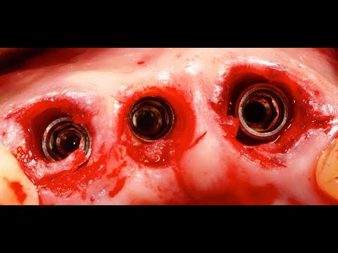 FLAPLESS AND POST-EXTRACTIVE IMMEDIATE IMPLANT LOADING IN AESTHETIC ZONE