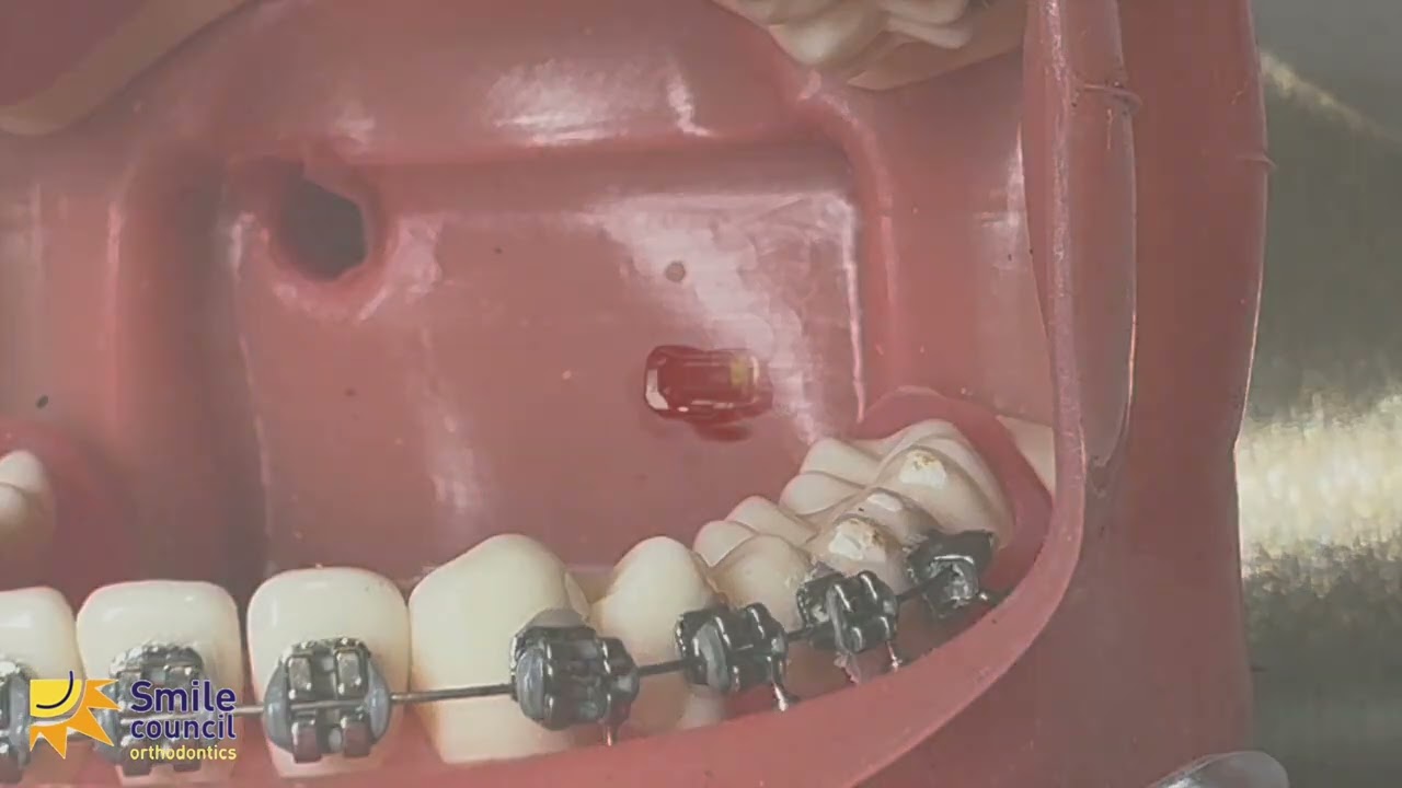 Braces