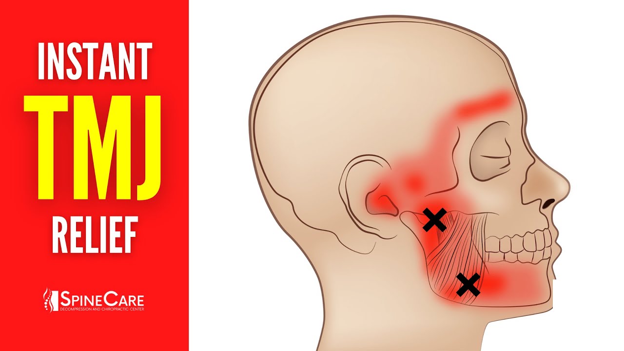 How to Relieve TMJ Pain at Home | 30 SECOND RELIEF