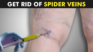 Sclerotherapy: A Safe and Effective Solution for Spider Veins and Varicose Veins