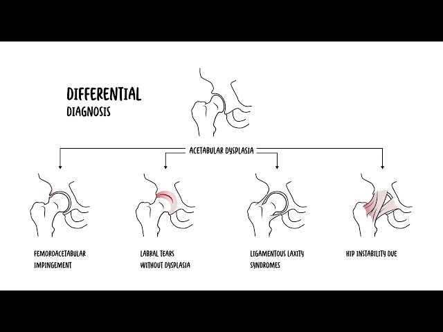 Acetabular Dysplasia (Hip Dysplasia): Symptoms, Imaging and Treatment & Explained