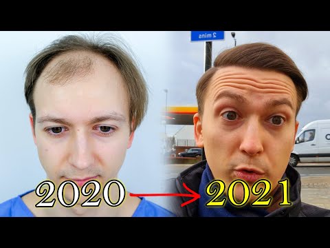 FUE Hair Transplant Growth Timeline | Before & After